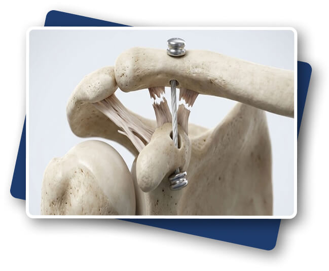 Entorses et Luxations Acromio-claviculaires